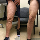 Superior Varicose Venas Spray